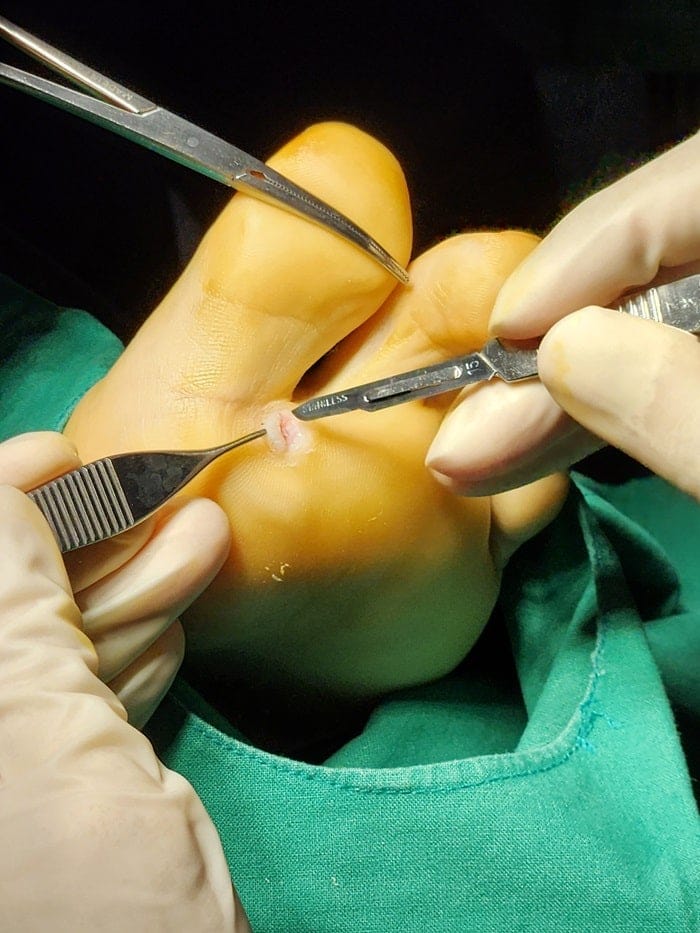 Plantar Wart Removal: Why You Need a Specialist Clinic to Prevent Recurrence — 8