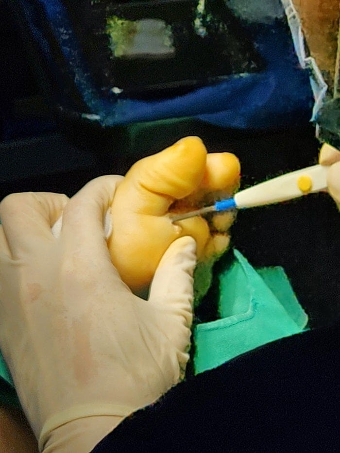 Plantar Wart Removal: Why You Need a Specialist Clinic to Prevent Recurrence — 9