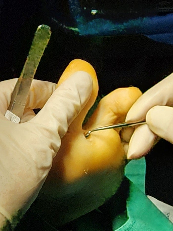 Plantar Wart Removal: Why You Need a Specialist Clinic to Prevent Recurrence — 10