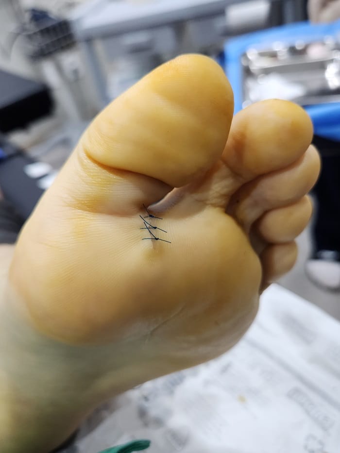 Plantar Wart Removal: Why You Need a Specialist Clinic to Prevent Recurrence — 11