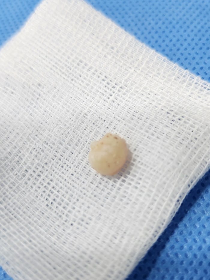 Plantar Wart Removal: Why You Need a Specialist Clinic to Prevent Recurrence — 12