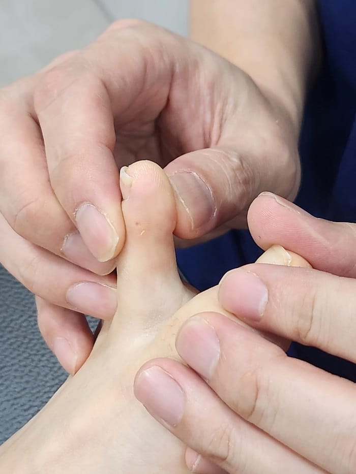 Toe Corns and Interdigital Corns: Why You Need a Foot Specialist for Lasting Removal