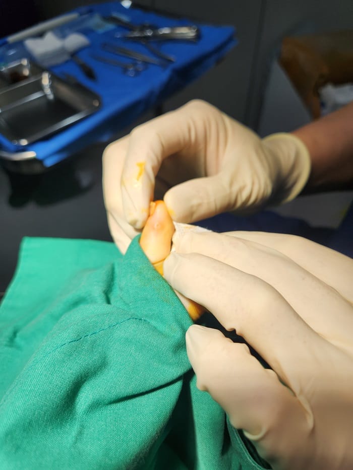 Toe Corns and Interdigital Corns: Why You Need a Foot Specialist for Lasting Removal — 3