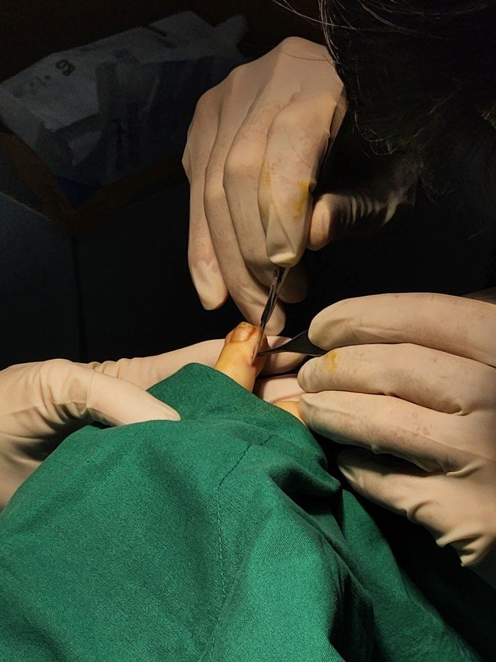 Toe Corns and Interdigital Corns: Why You Need a Foot Specialist for Lasting Removal — 4
