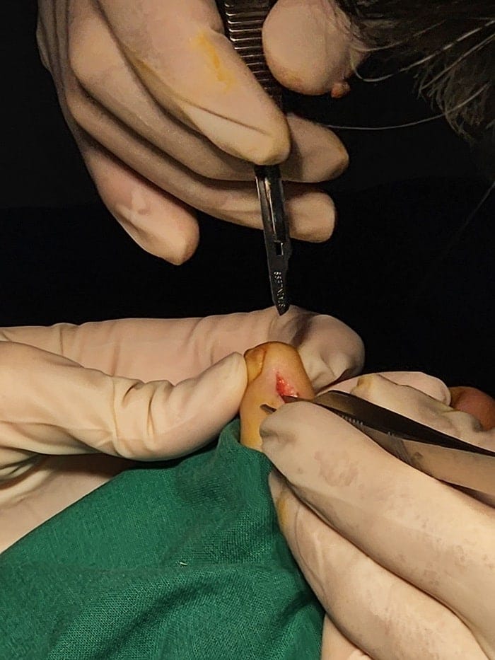 Toe Corns and Interdigital Corns: Why You Need a Foot Specialist for Lasting Removal — 5
