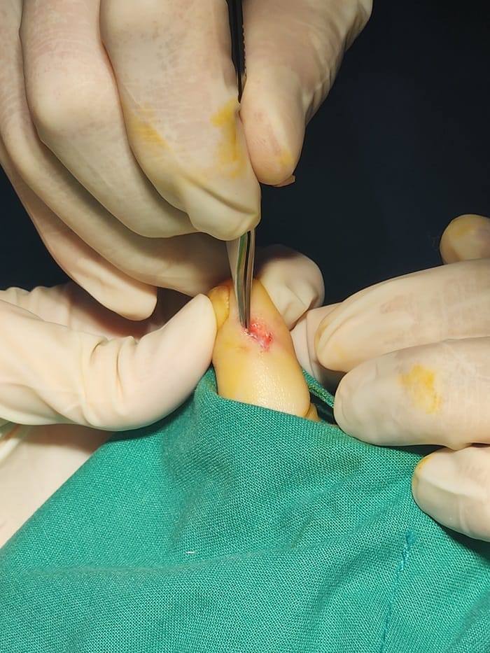 Toe Corns and Interdigital Corns: Why You Need a Foot Specialist for Lasting Removal — 6
