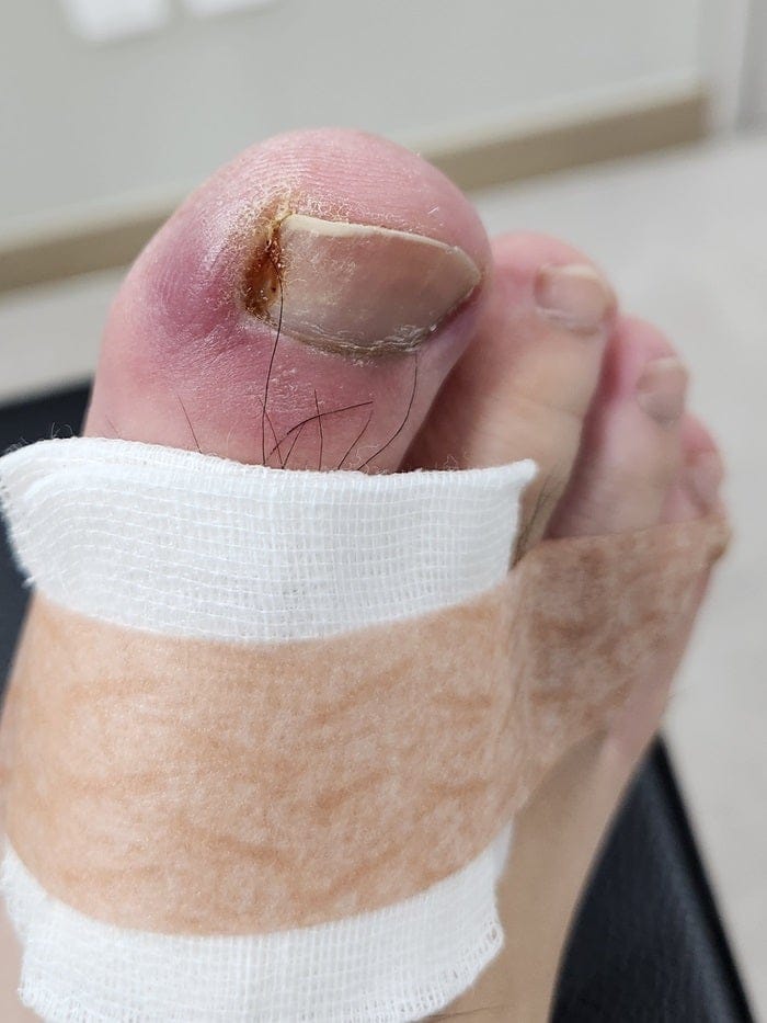Ingrown Toenail Removal Surgery for Pus, Pain, and Inflammation — Nail Correction Without Self-Treatment