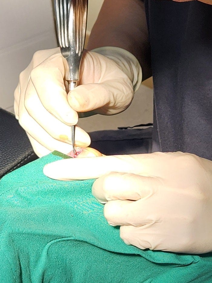 Ingrown Toenail Removal Surgery for Pus, Pain, and Inflammation — Nail Correction Without Self-Treatment — 4
