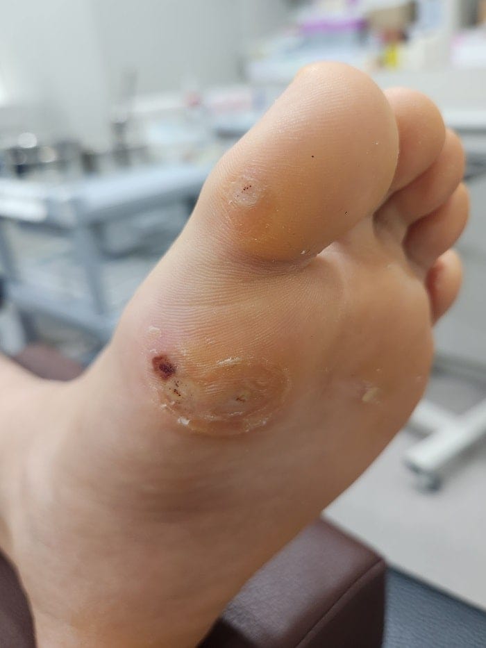 Plantar Wart Removal: Why Targeting the Root Cause Matters