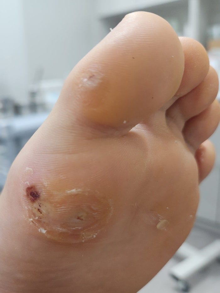 Plantar Wart Removal: Why Targeting the Root Cause Matters — 2