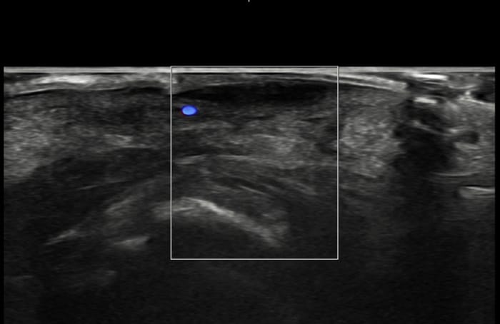 Plantar Wart Removal: Why Targeting the Root Cause Matters — 5