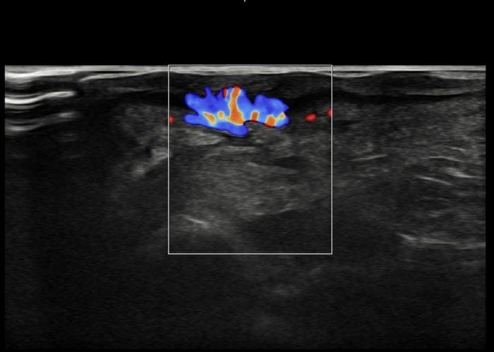 Plantar Wart Removal: Why Targeting the Root Cause Matters — 6
