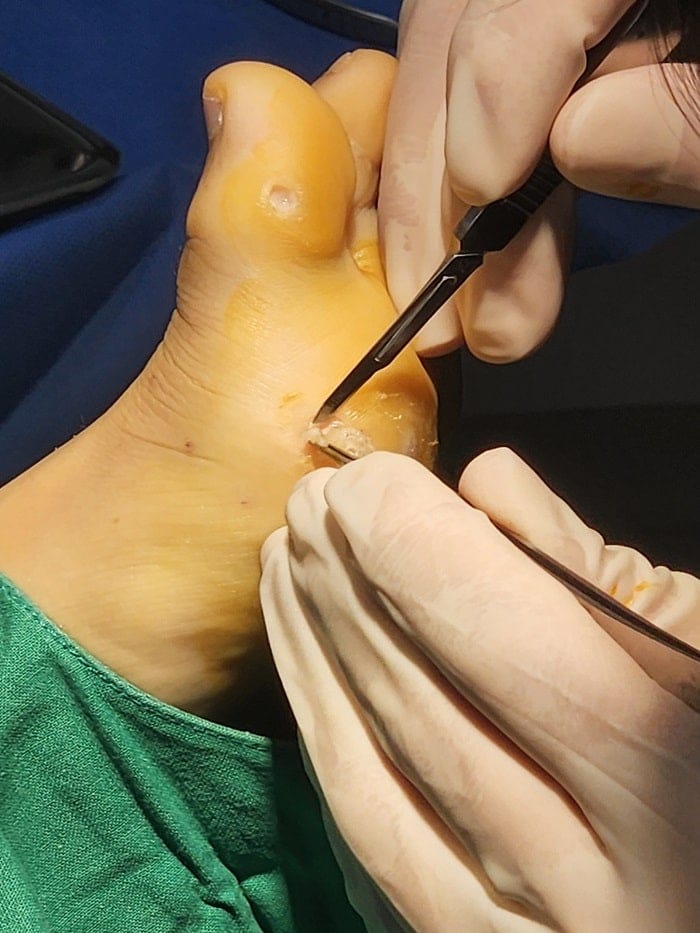 Plantar Wart Removal: Why Targeting the Root Cause Matters — 7