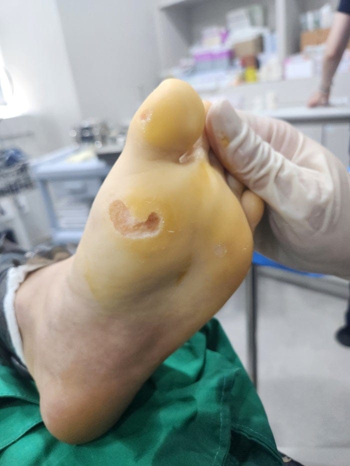 Plantar Wart Removal: Why Targeting the Root Cause Matters — 14