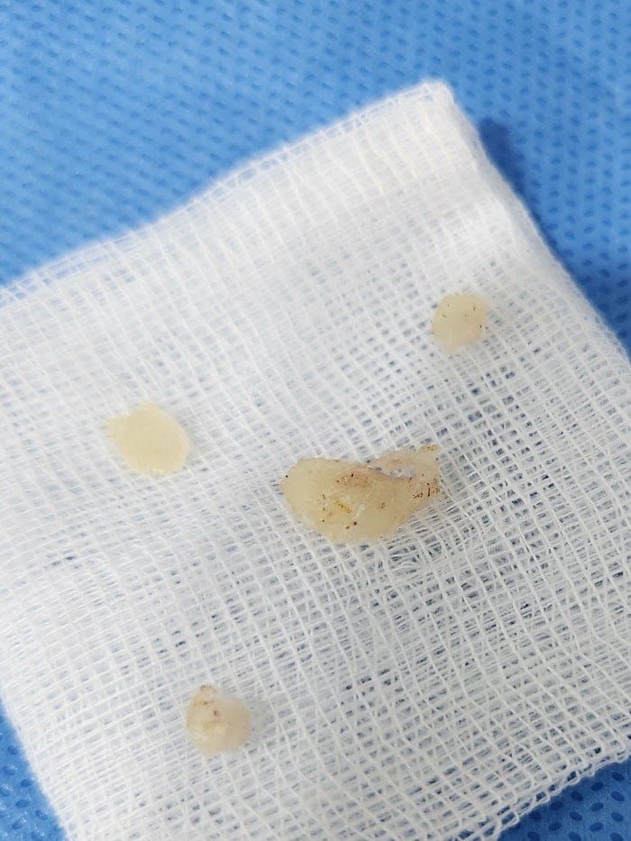 Plantar Wart Removal: Why Targeting the Root Cause Matters — 16