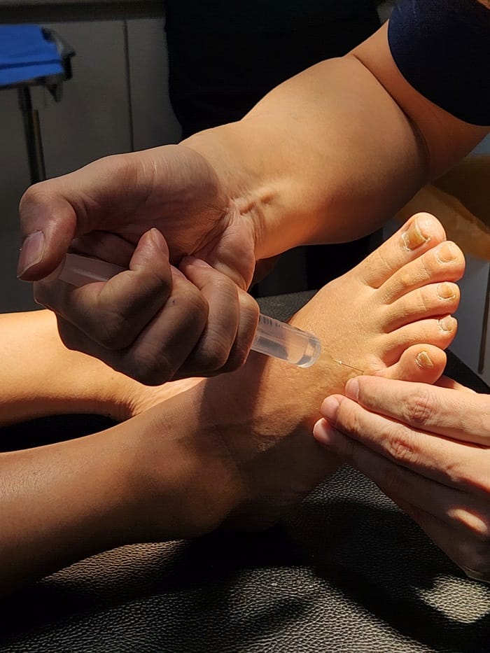 Corns on the Little Toe and Between Toes: An Orthopedic Foot Specialist Explains the Real Cause — 3