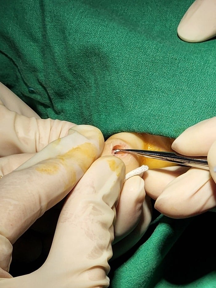 Corns on the Little Toe and Between Toes: An Orthopedic Foot Specialist Explains the Real Cause — 13