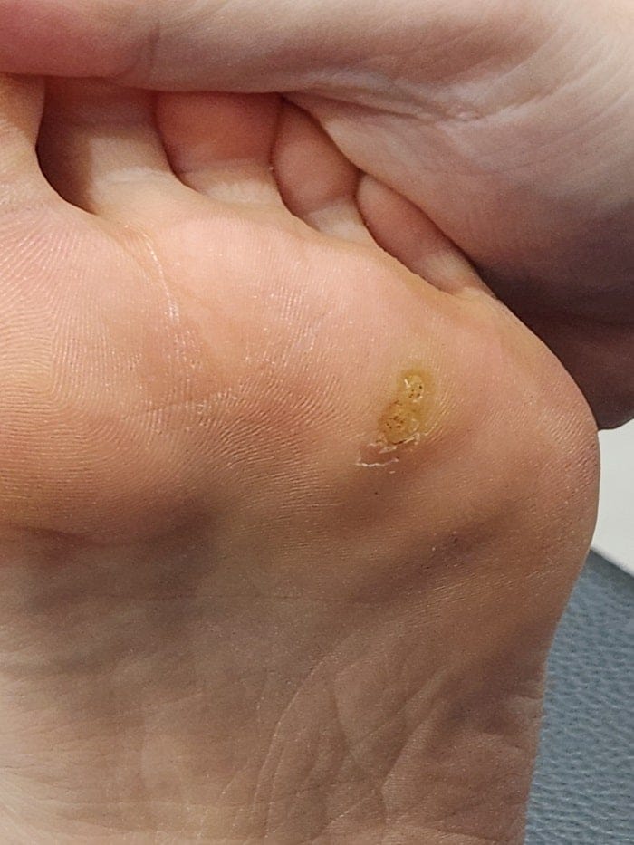 Plantar Wart Removal Surgery After 3 Failed Cryotherapy Sessions: Switching to a Specialist Clinic — 2