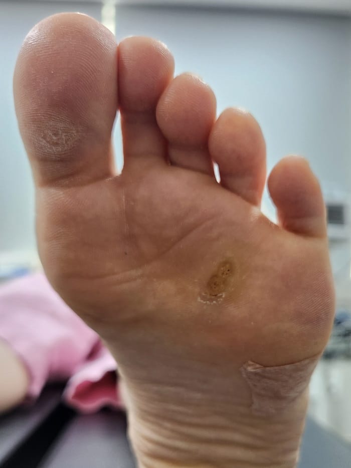 Plantar Wart Removal Surgery After 3 Failed Cryotherapy Sessions: Switching to a Specialist Clinic — 3