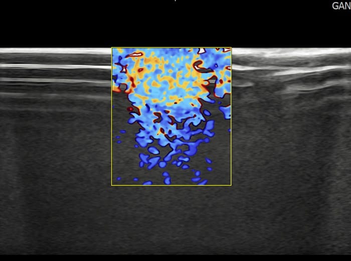 Plantar Wart Removal Surgery After 3 Failed Cryotherapy Sessions: Switching to a Specialist Clinic — 4