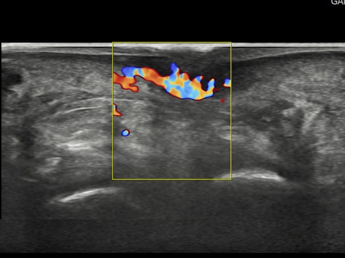 Plantar Wart Removal Surgery After 3 Failed Cryotherapy Sessions: Switching to a Specialist Clinic — 5