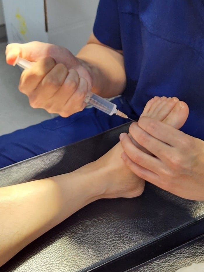 Plantar Wart Removal Surgery After 3 Failed Cryotherapy Sessions: Switching to a Specialist Clinic — 6