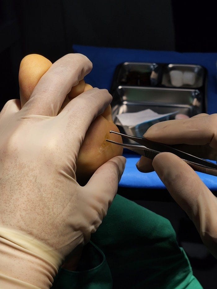 Plantar Wart Removal Surgery After 3 Failed Cryotherapy Sessions: Switching to a Specialist Clinic — 8