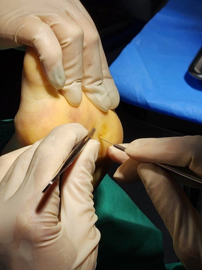 Plantar Wart Removal Surgery After 3 Failed Cryotherapy Sessions: Switching to a Specialist Clinic — 9