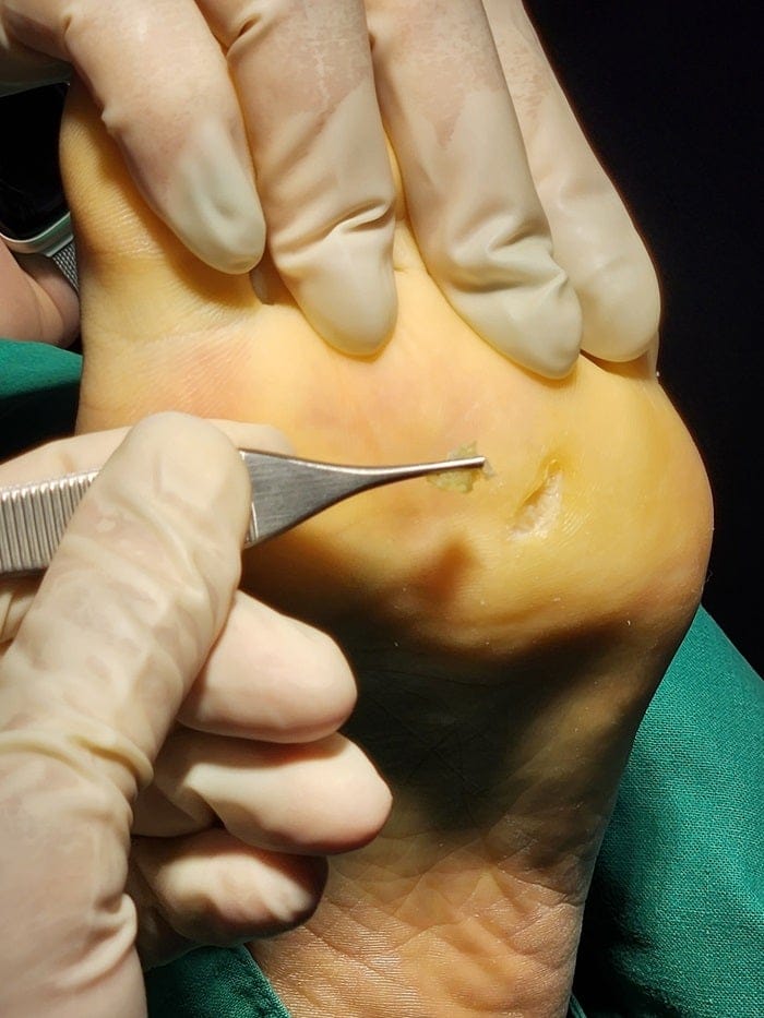 Plantar Wart Removal Surgery After 3 Failed Cryotherapy Sessions: Switching to a Specialist Clinic — 11