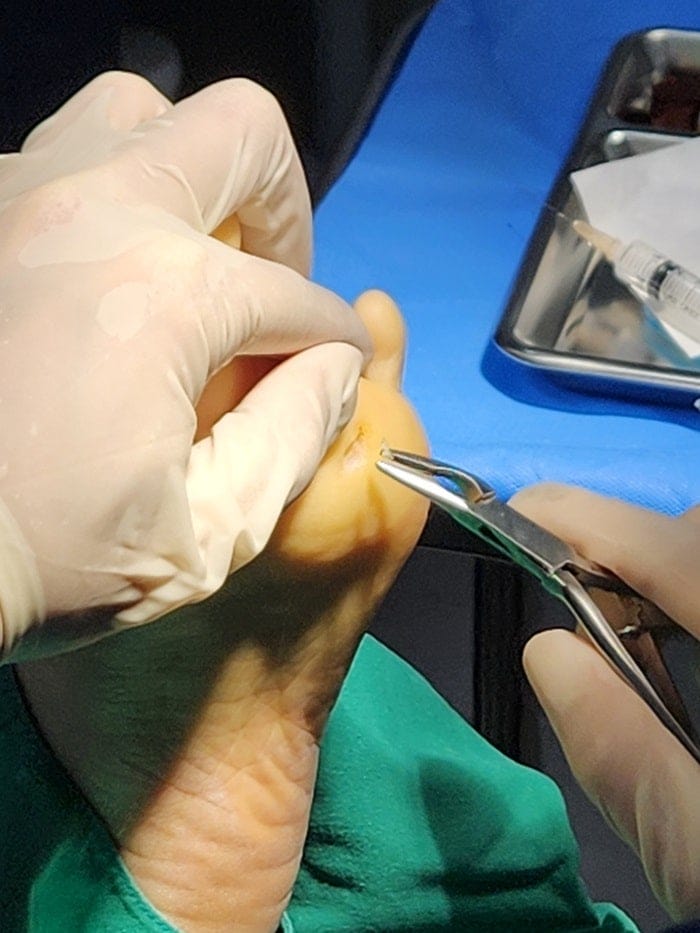 Plantar Wart Removal Surgery After 3 Failed Cryotherapy Sessions: Switching to a Specialist Clinic — 12