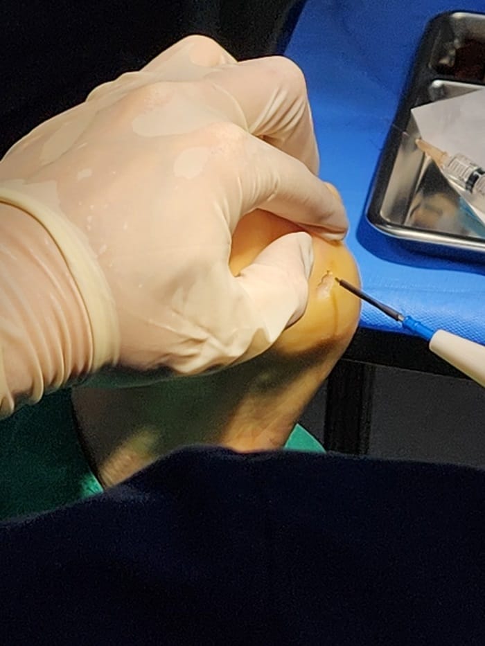 Plantar Wart Removal Surgery After 3 Failed Cryotherapy Sessions: Switching to a Specialist Clinic — 13