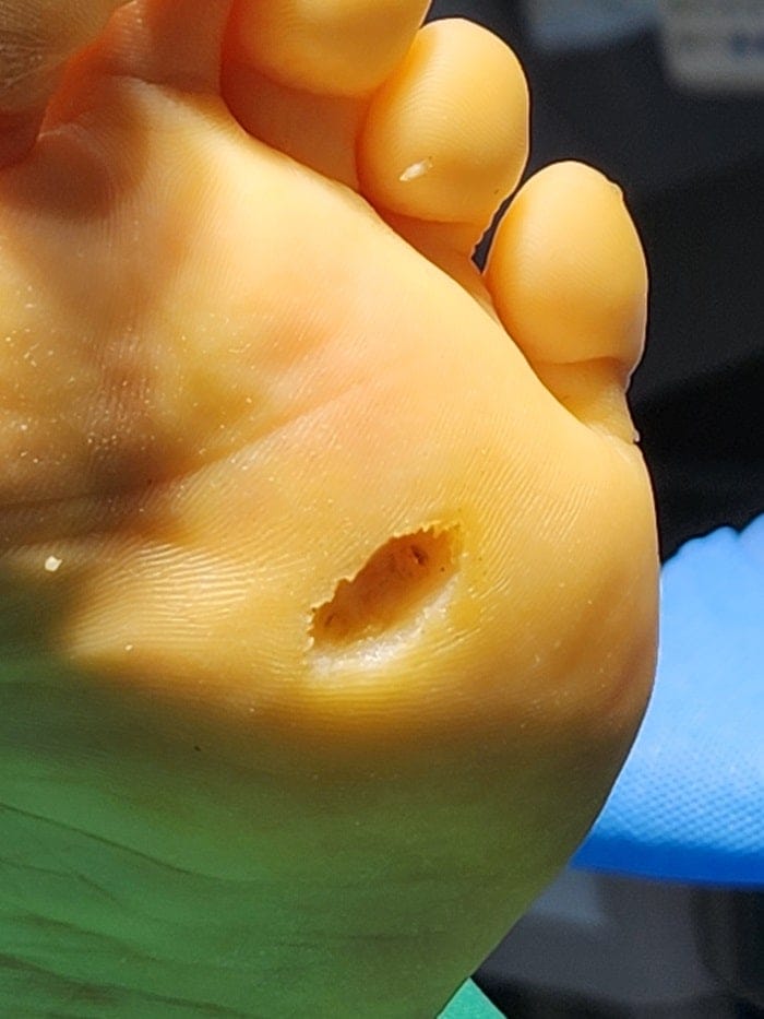 Plantar Wart Removal Surgery After 3 Failed Cryotherapy Sessions: Switching to a Specialist Clinic — 14
