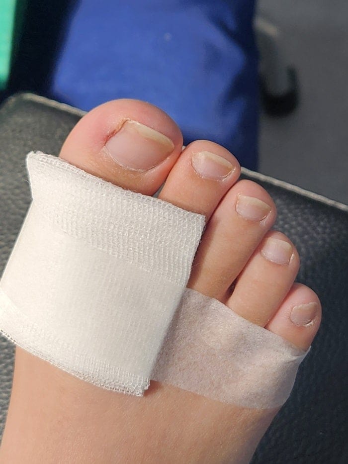 Ingrown Toenail on the Big Toe: Why an Accurate Diagnosis Matters for Nail Piercing, Pus, Curved Nails, and Toe Pain