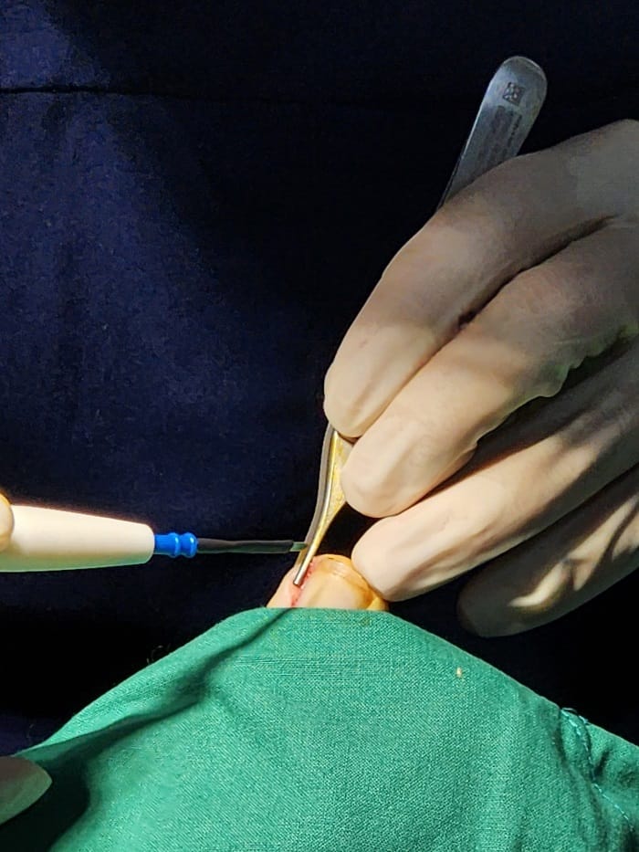 Ingrown Toenail on the Big Toe: Why an Accurate Diagnosis Matters for Nail Piercing, Pus, Curved Nails, and Toe Pain — 6