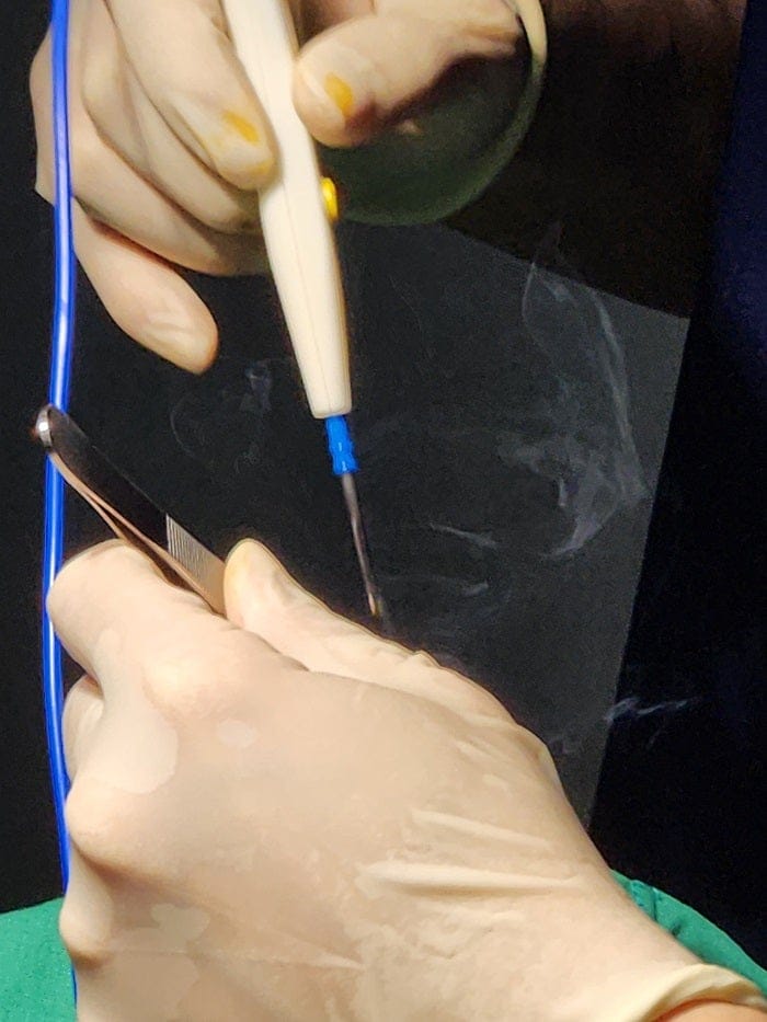 Ingrown Toenail on the Big Toe: Why an Accurate Diagnosis Matters for Nail Piercing, Pus, Curved Nails, and Toe Pain — 7