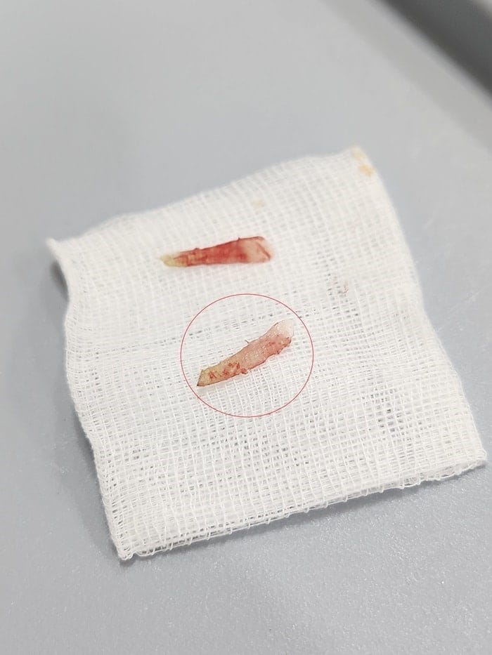 Ingrown Toenail on the Big Toe: Why an Accurate Diagnosis Matters for Nail Piercing, Pus, Curved Nails, and Toe Pain — 9