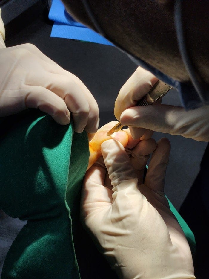 Pinky Toe Corn, Callus & Pain: Why You Need a Foot Orthopedic Specialist — 9