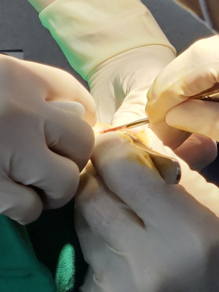 Pinky Toe Corn, Callus & Pain: Why You Need a Foot Orthopedic Specialist — 11