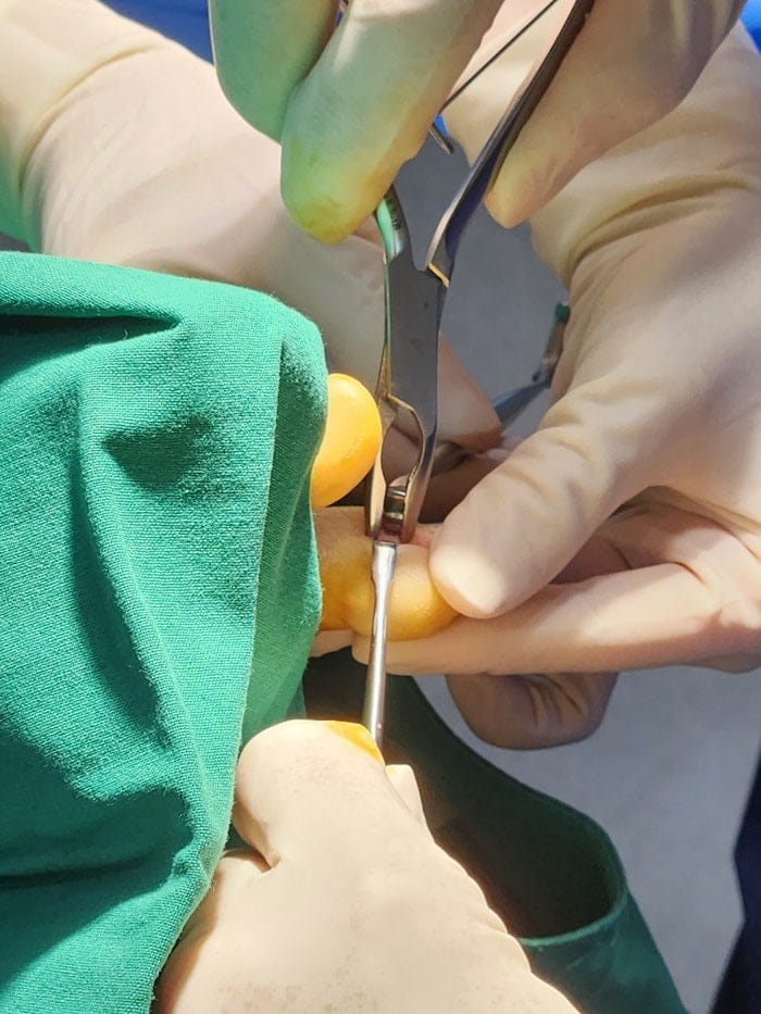 Pinky Toe Corn, Callus & Pain: Why You Need a Foot Orthopedic Specialist — 12