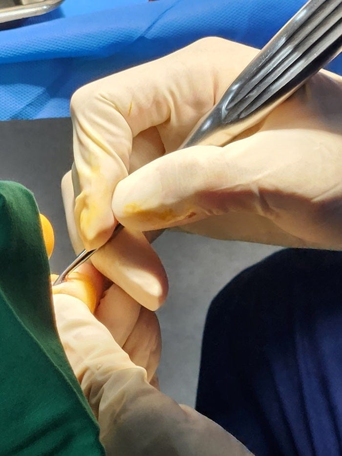 Pinky Toe Corn, Callus & Pain: Why You Need a Foot Orthopedic Specialist — 15