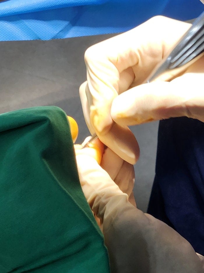 Pinky Toe Corn, Callus & Pain: Why You Need a Foot Orthopedic Specialist — 16