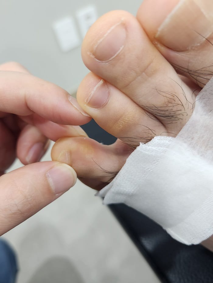 Fourth Toe Blister, Corn, and Callus Pain — Why Accurate Cause Removal Matters