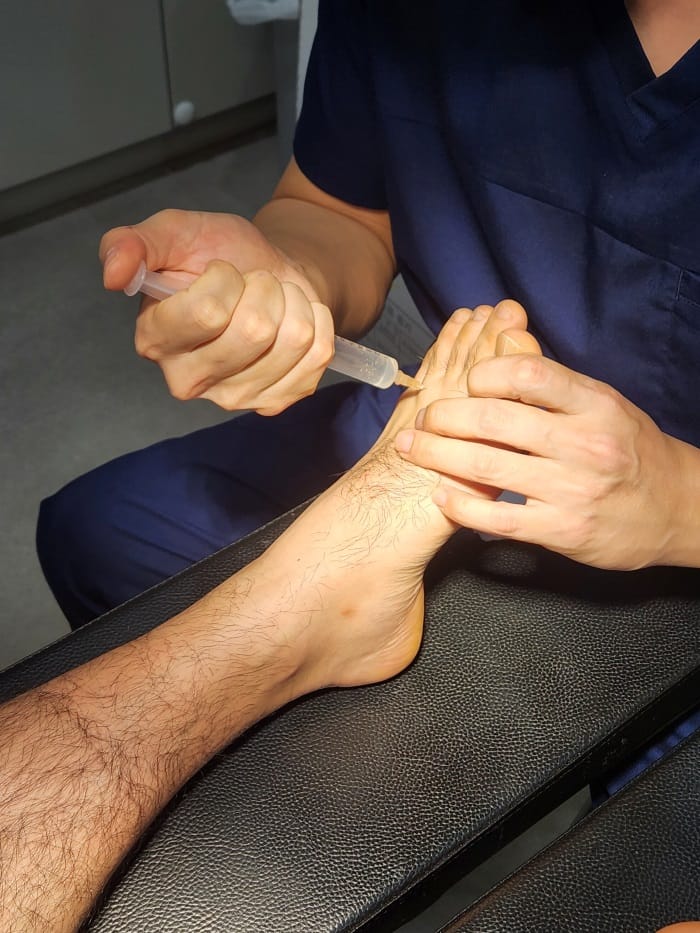 Fourth Toe Blister, Corn, and Callus Pain — Why Accurate Cause Removal Matters — 2