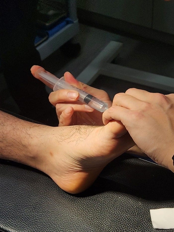 Fourth Toe Blister, Corn, and Callus Pain — Why Accurate Cause Removal Matters — 3