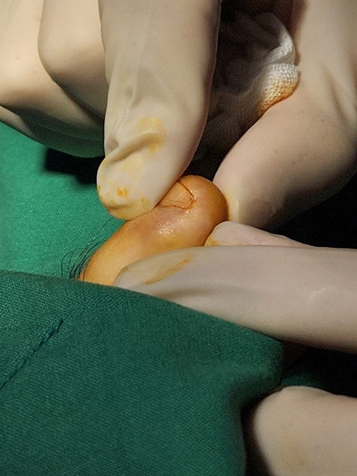Fourth Toe Blister, Corn, and Callus Pain — Why Accurate Cause Removal Matters — 5