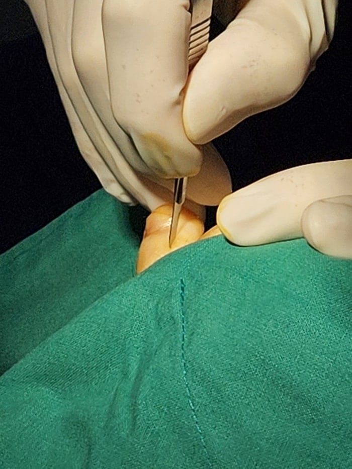 Fourth Toe Blister, Corn, and Callus Pain — Why Accurate Cause Removal Matters — 6