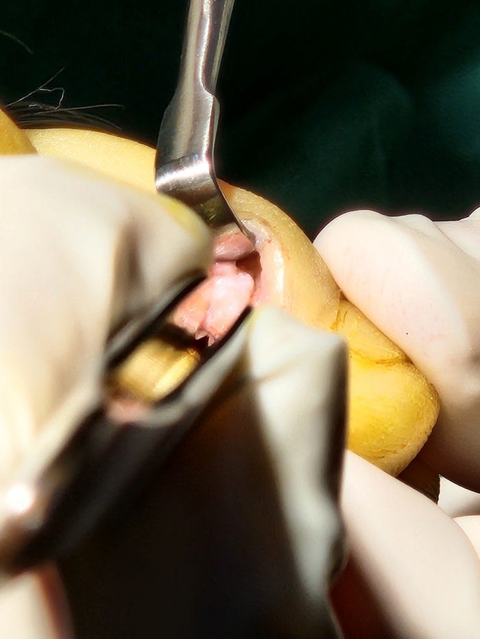 Fourth Toe Blister, Corn, and Callus Pain — Why Accurate Cause Removal Matters — 11