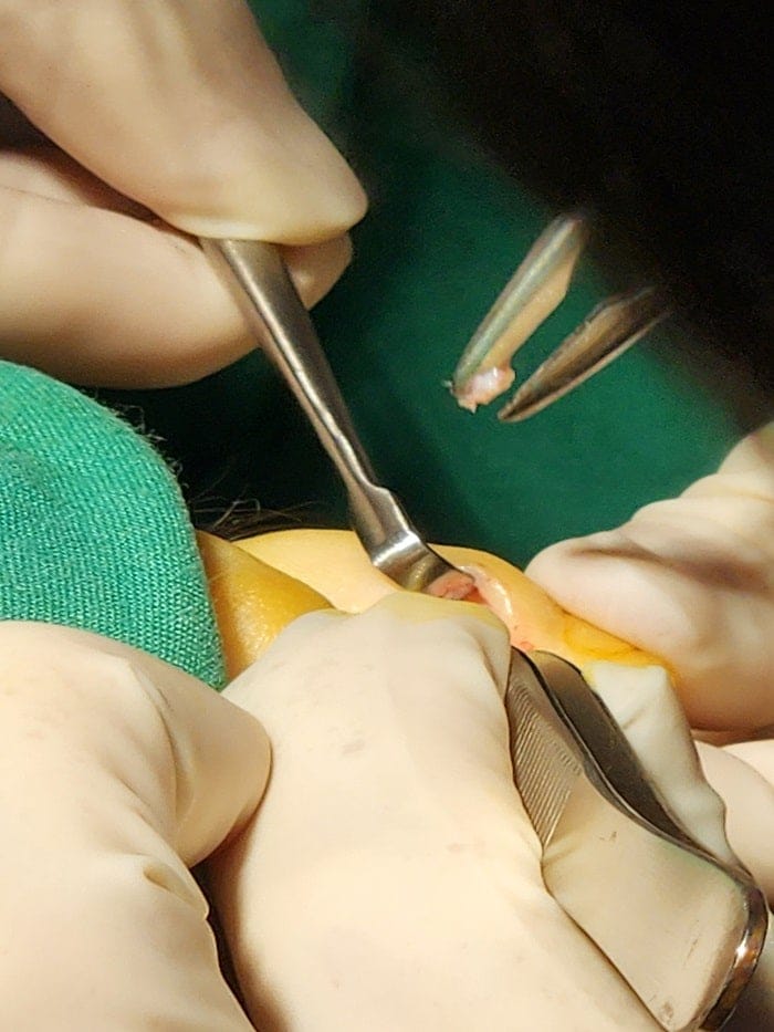 Fourth Toe Blister, Corn, and Callus Pain — Why Accurate Cause Removal Matters — 12
