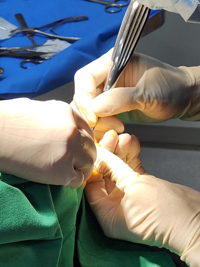 Fourth Toe Blister, Corn, and Callus Pain — Why Accurate Cause Removal Matters — 13