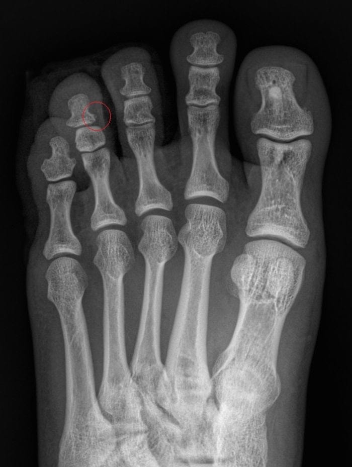 Fourth Toe Blister, Corn, and Callus Pain — Why Accurate Cause Removal Matters — 16